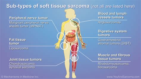 imaging tests for adult soft tissue sarcoma|soft tissue cancer survival rate.